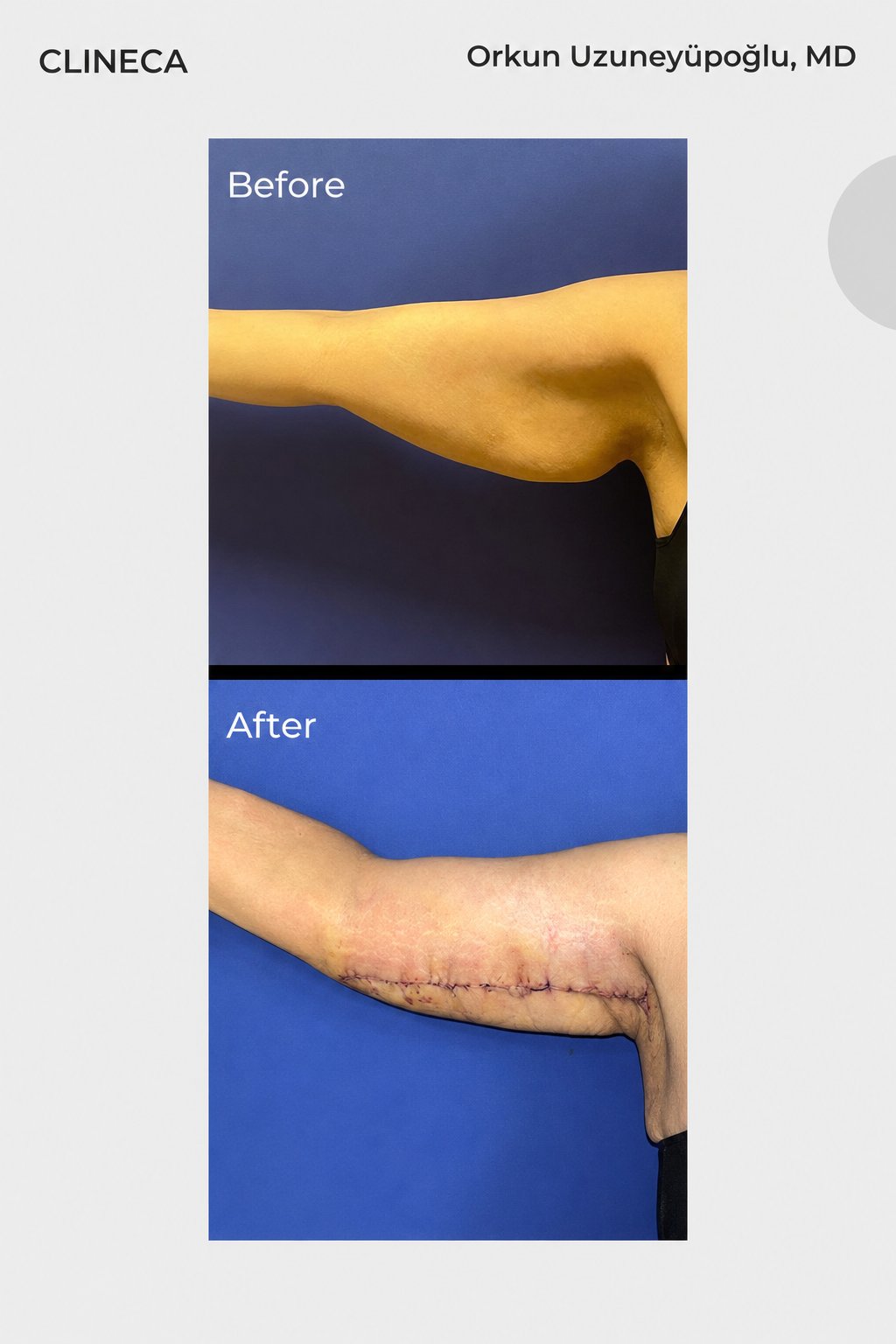 Before and after arm lift at Clineca: loose upper-arm skin before surgery, and the long inner-arm incision line still fresh in the early weeks after