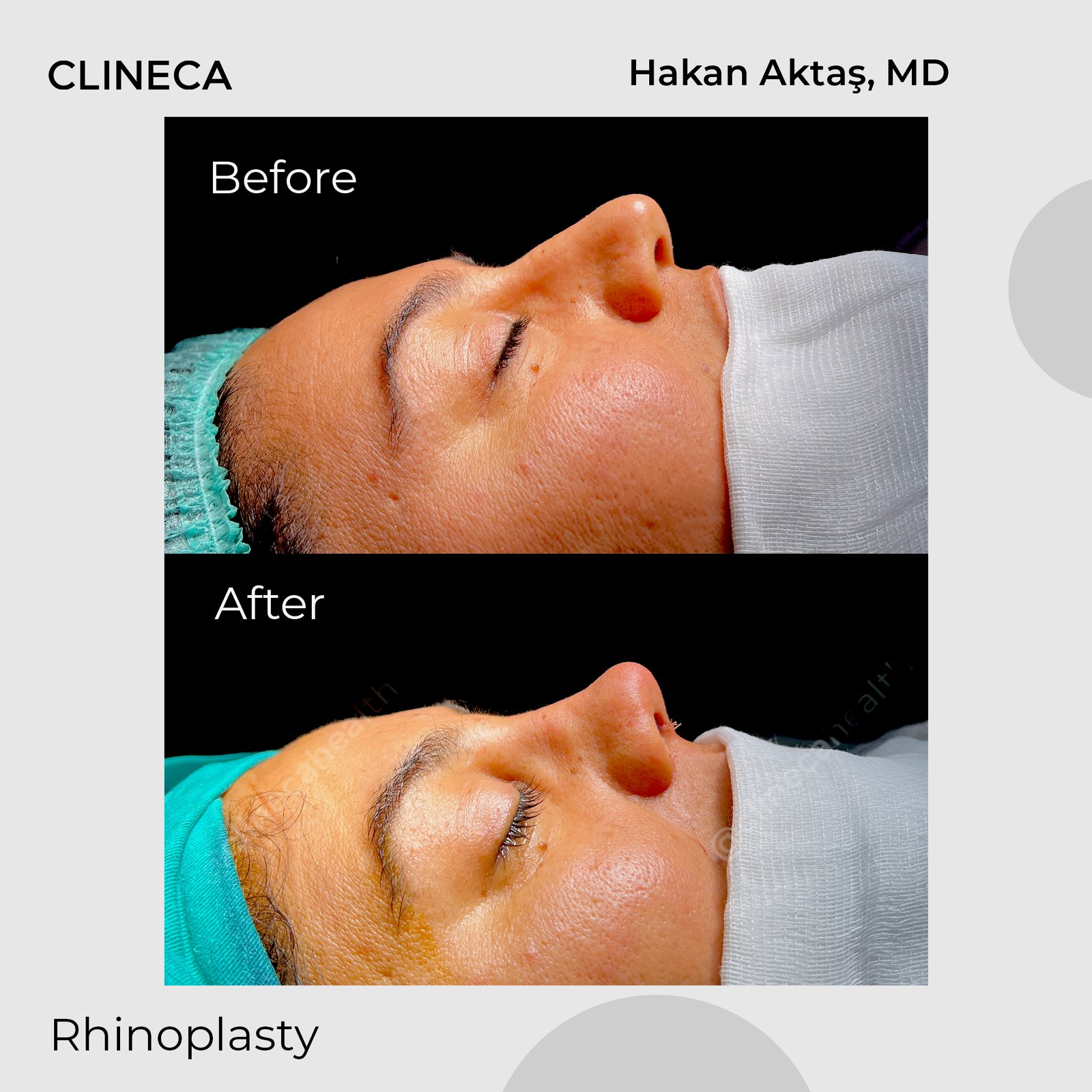 Standardised before and after photos of a real Clineca primary rhinoplasty patient by Hakan Aktas, MD