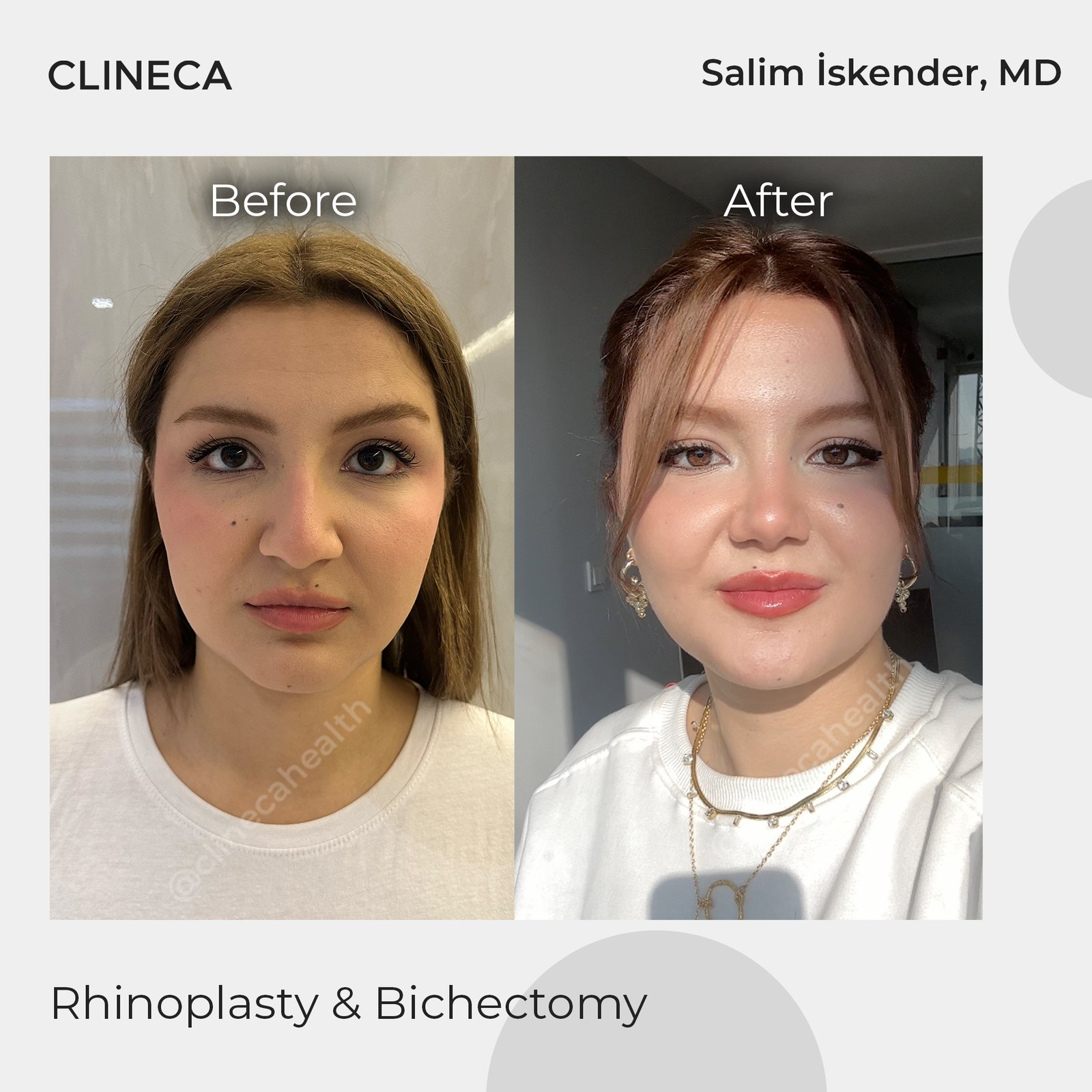 Before and after combined rhinoplasty and buccal fat removal at Clineca by Salim Iskender, MD