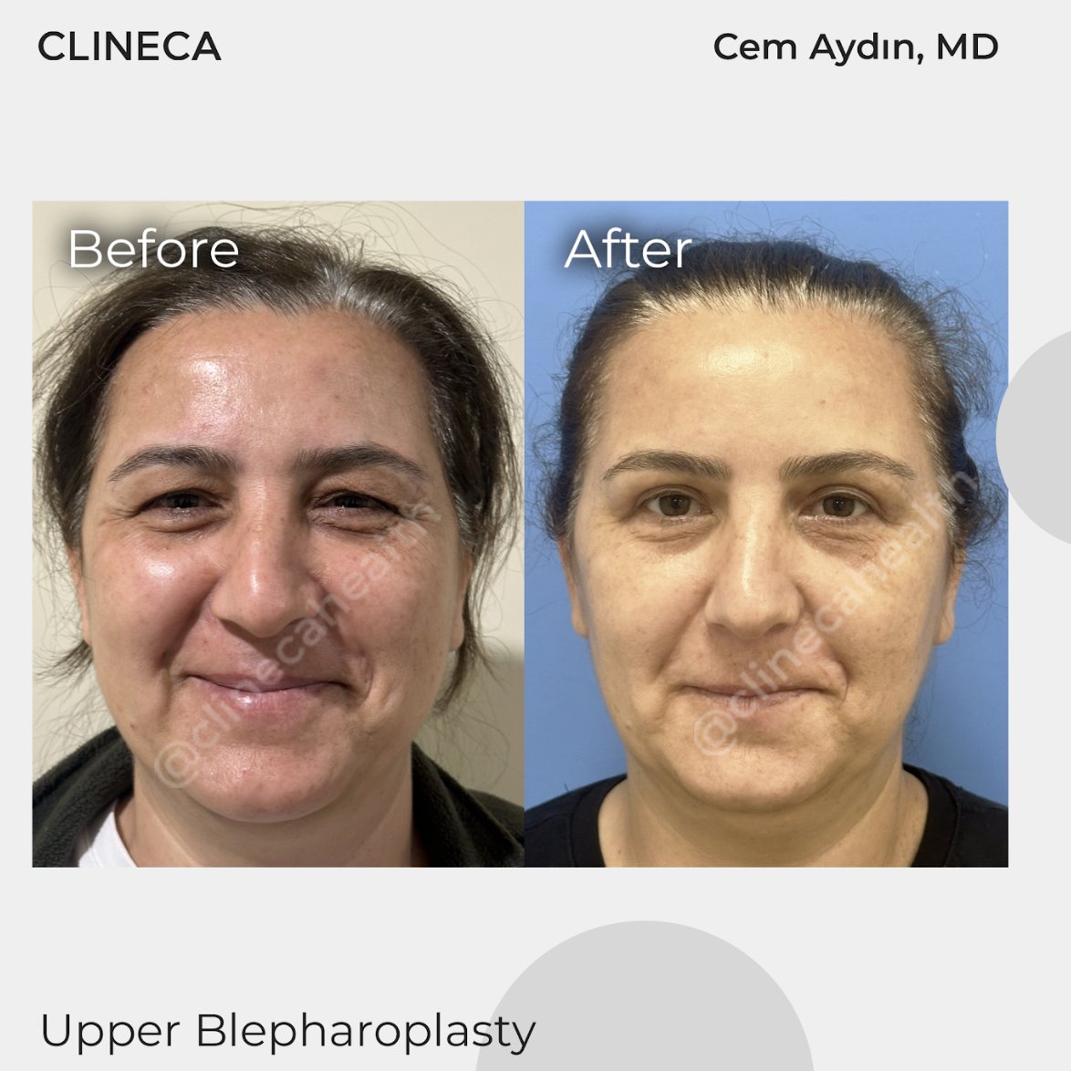 Before and after upper blepharoplasty at Clineca by Cem Aydin, MD