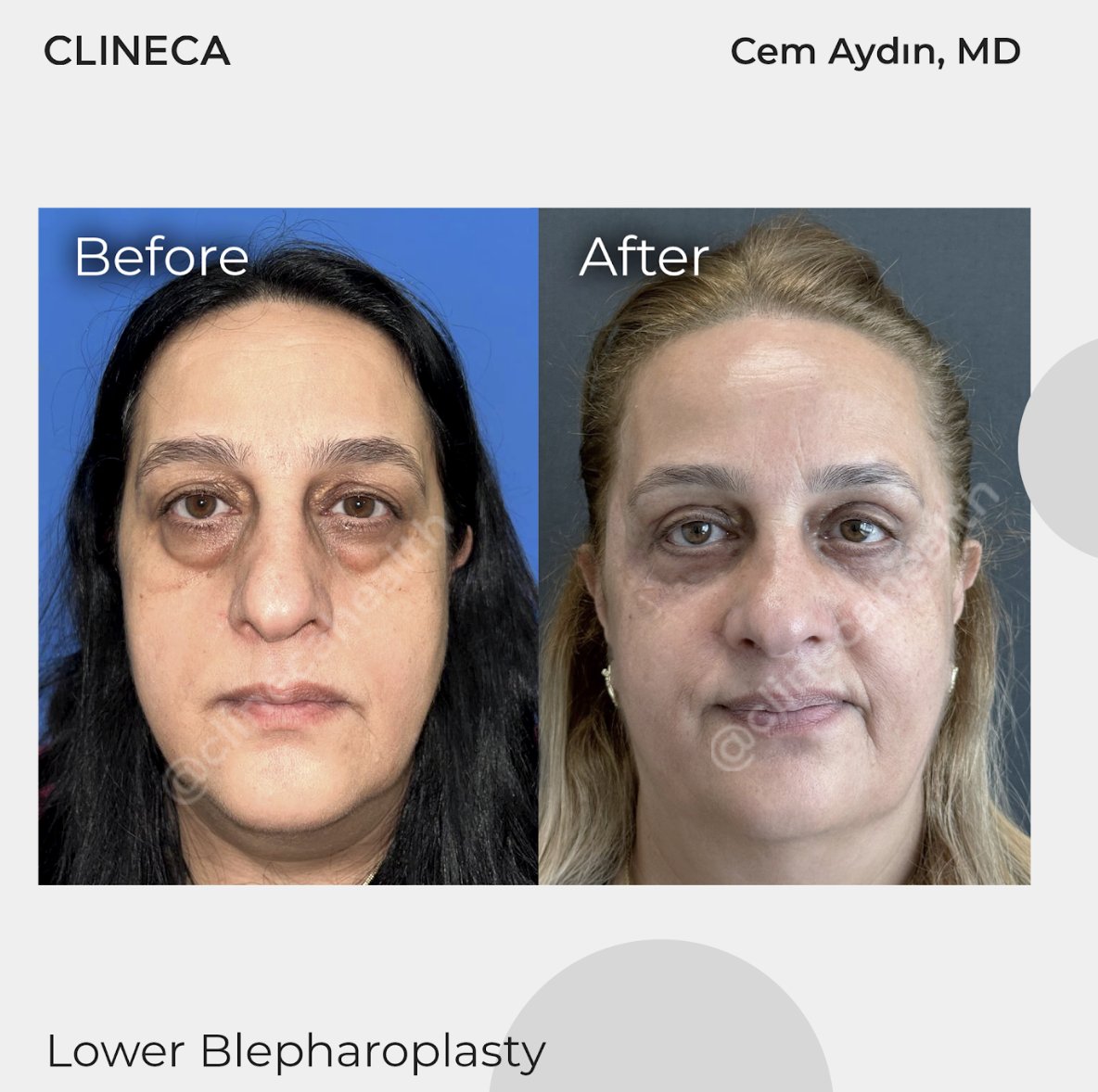 Before and after lower blepharoplasty at Clineca by Cem Aydin, MD: under-eye bags smoothed, with natural skin tone remaining