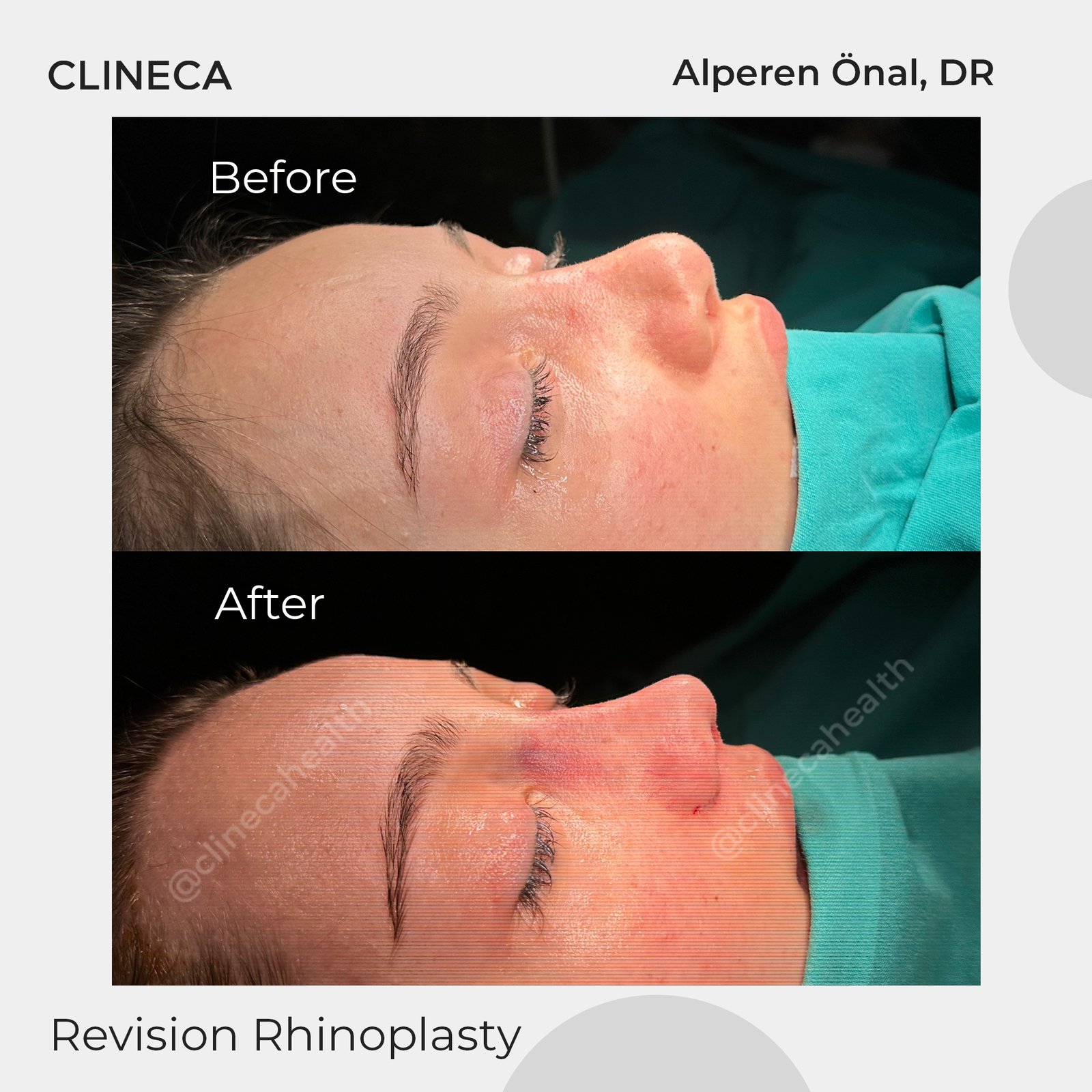 Before and after revision rhinoplasty at Clineca by Alperen Onal, MD, photographed right after surgery