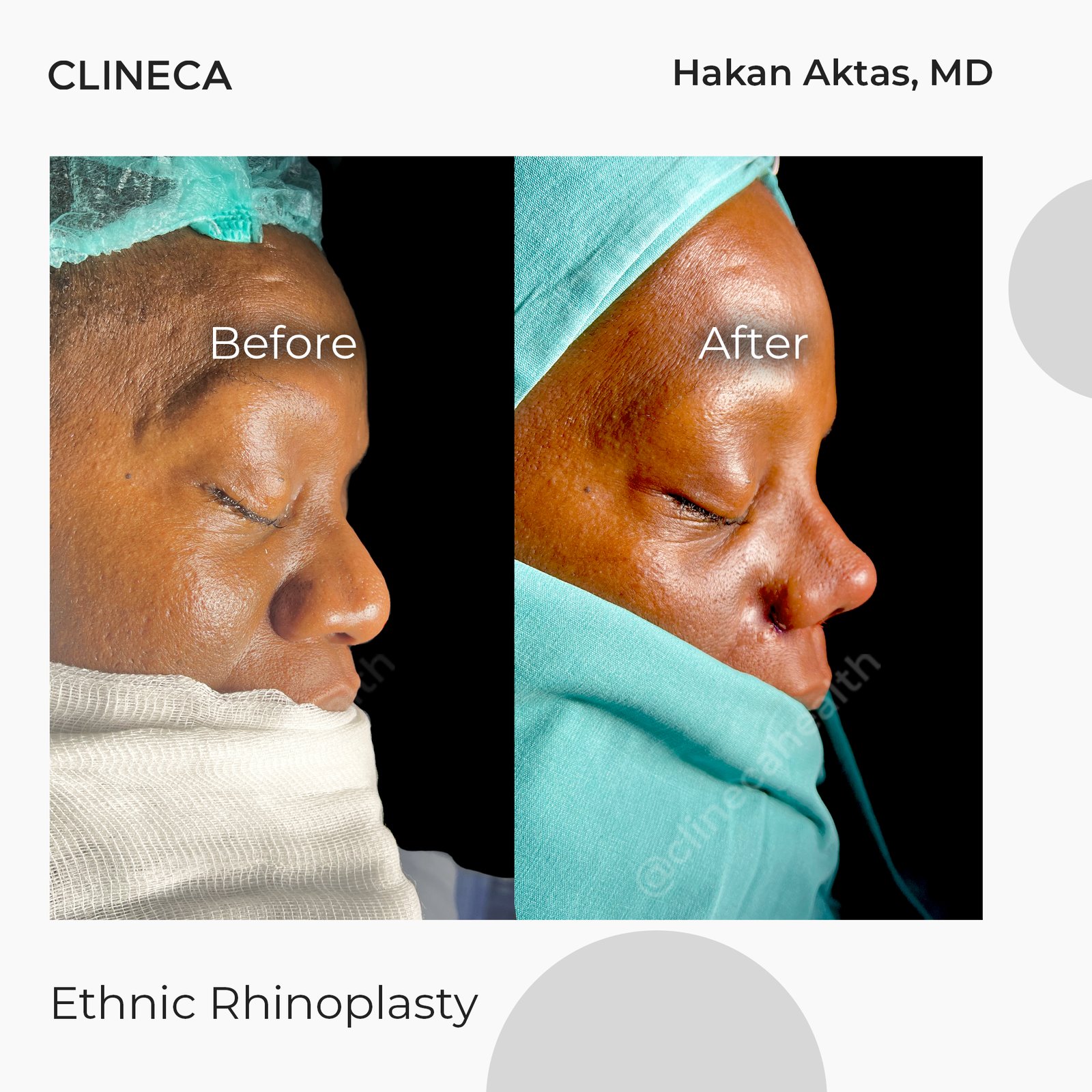 Before and after ethnic rhinoplasty at Clineca by Hakan Aktas, MD, photographed right after surgery