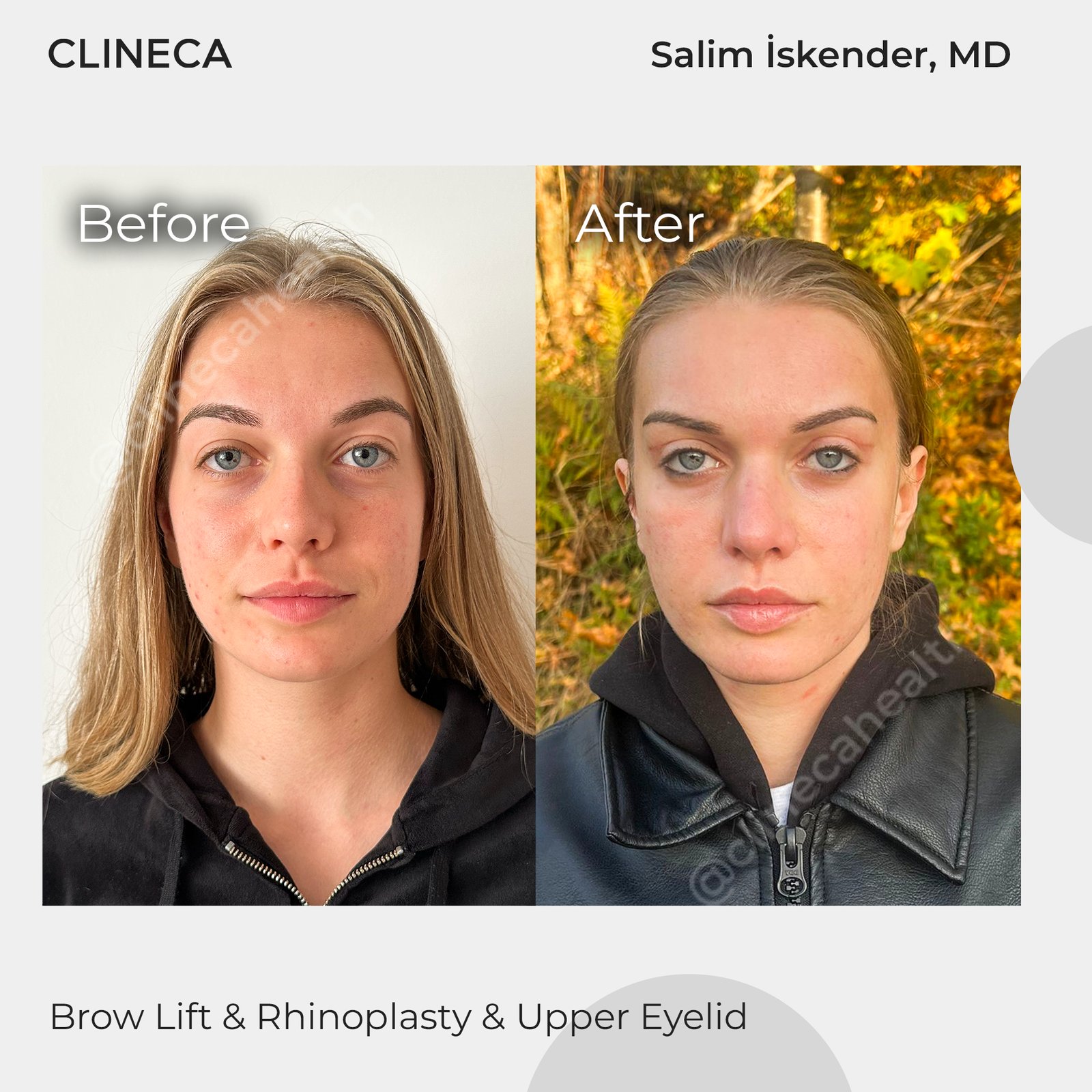 Before and after combined brow lift, rhinoplasty and upper eyelid surgery at Clineca by Salim Iskender, MD