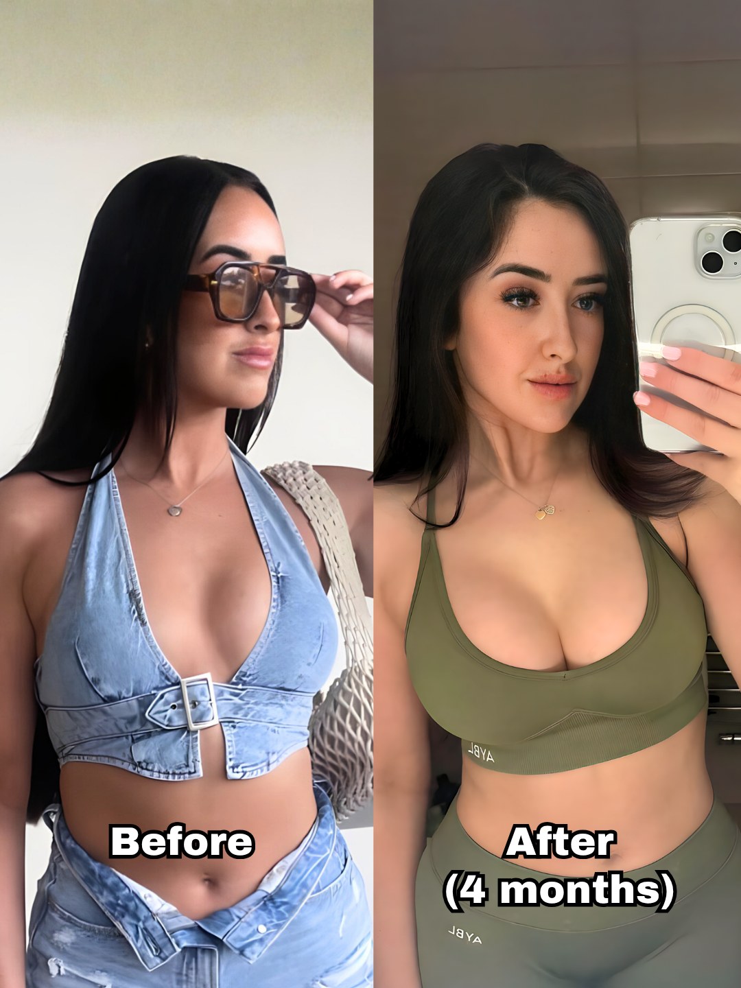 Breast augmentation patient before surgery and four months after
