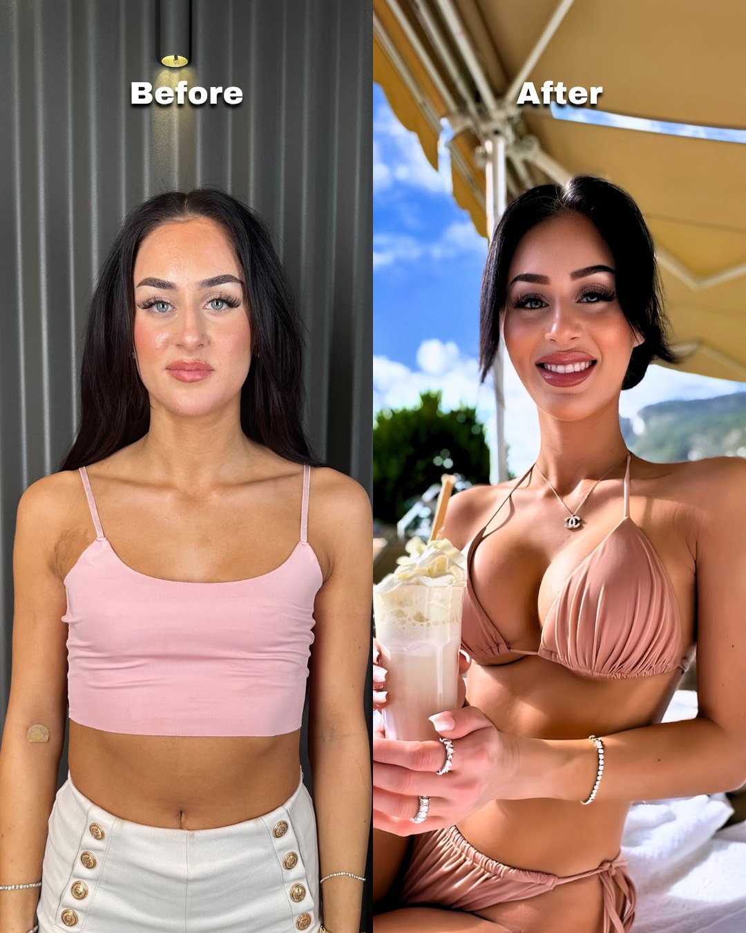 Breast augmentation patient before surgery and after