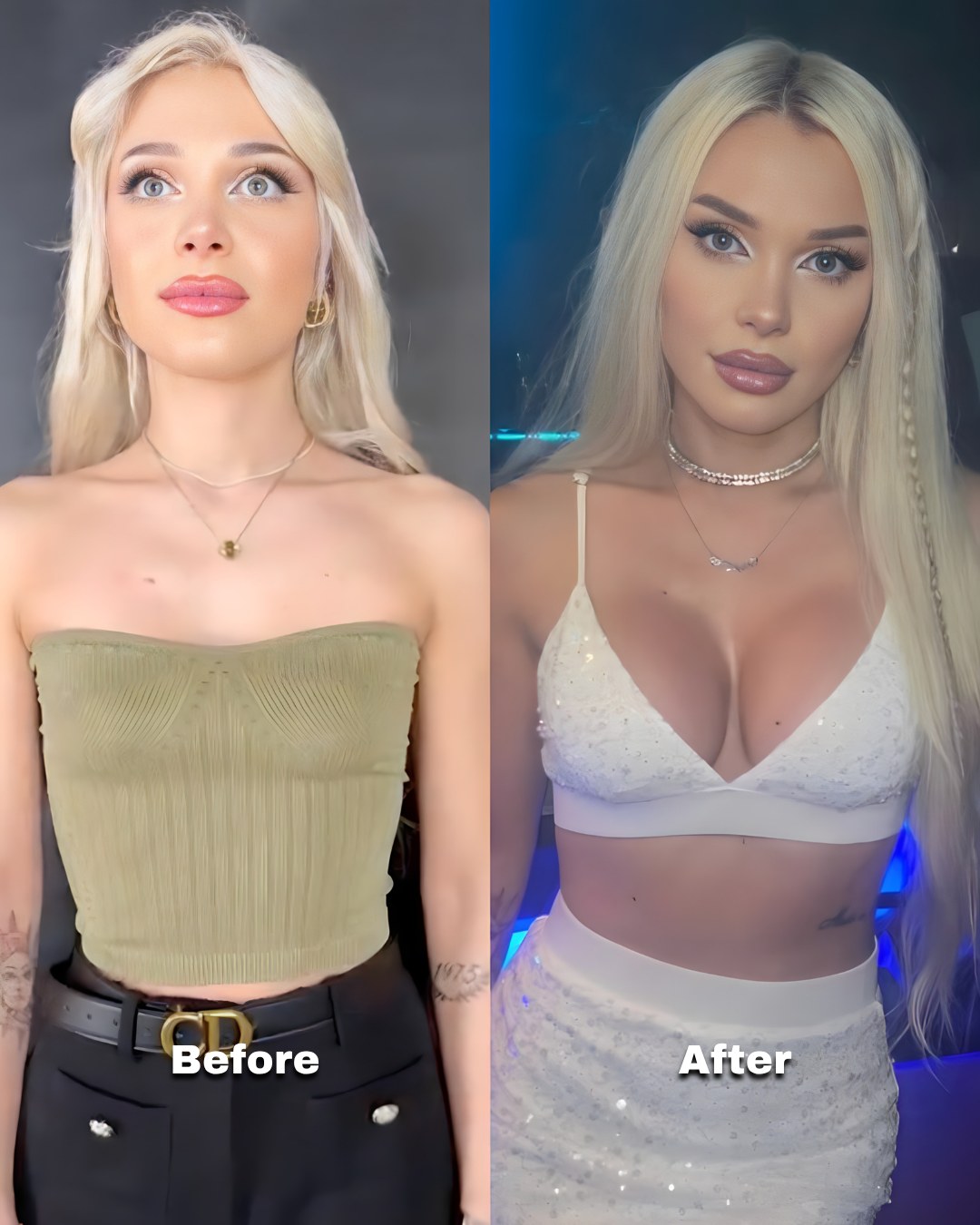 Breast surgery patient before and after, showing volume in proportion to her frame