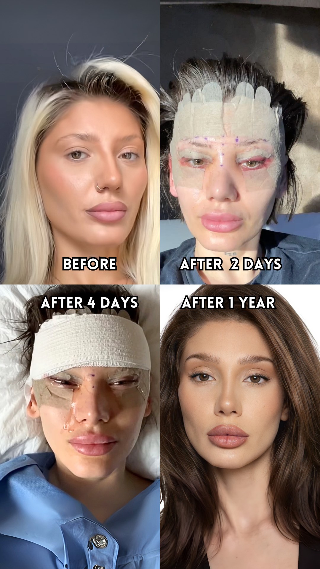 Patient before upper-face surgery, two days after with forehead and eyelid dressings, four days after with a head bandage, and one year after