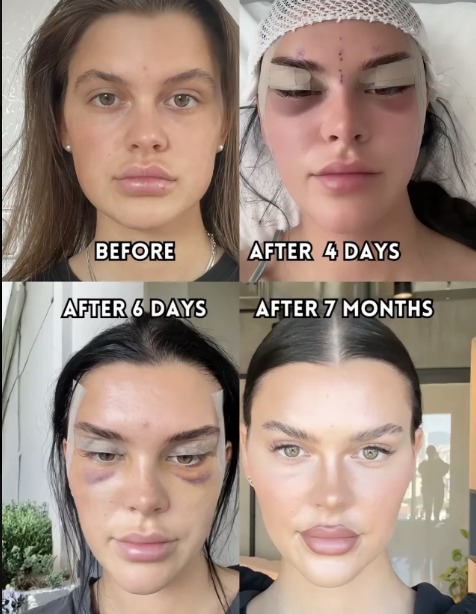 Patient before brow and eyelid surgery, four days after with dressings and bruising, six days after, and seven months after