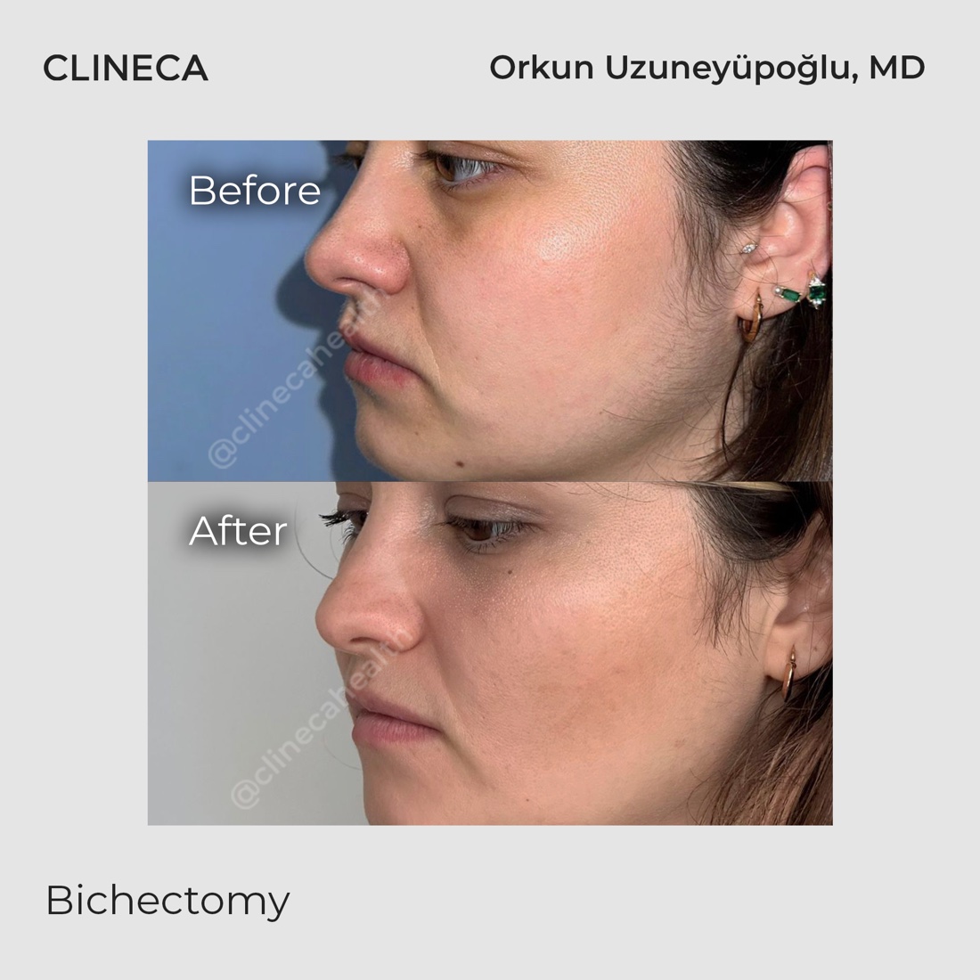 Buccal fat removal patient in the same three-quarter view before surgery and after, showing a slimmer transition below the cheekbone