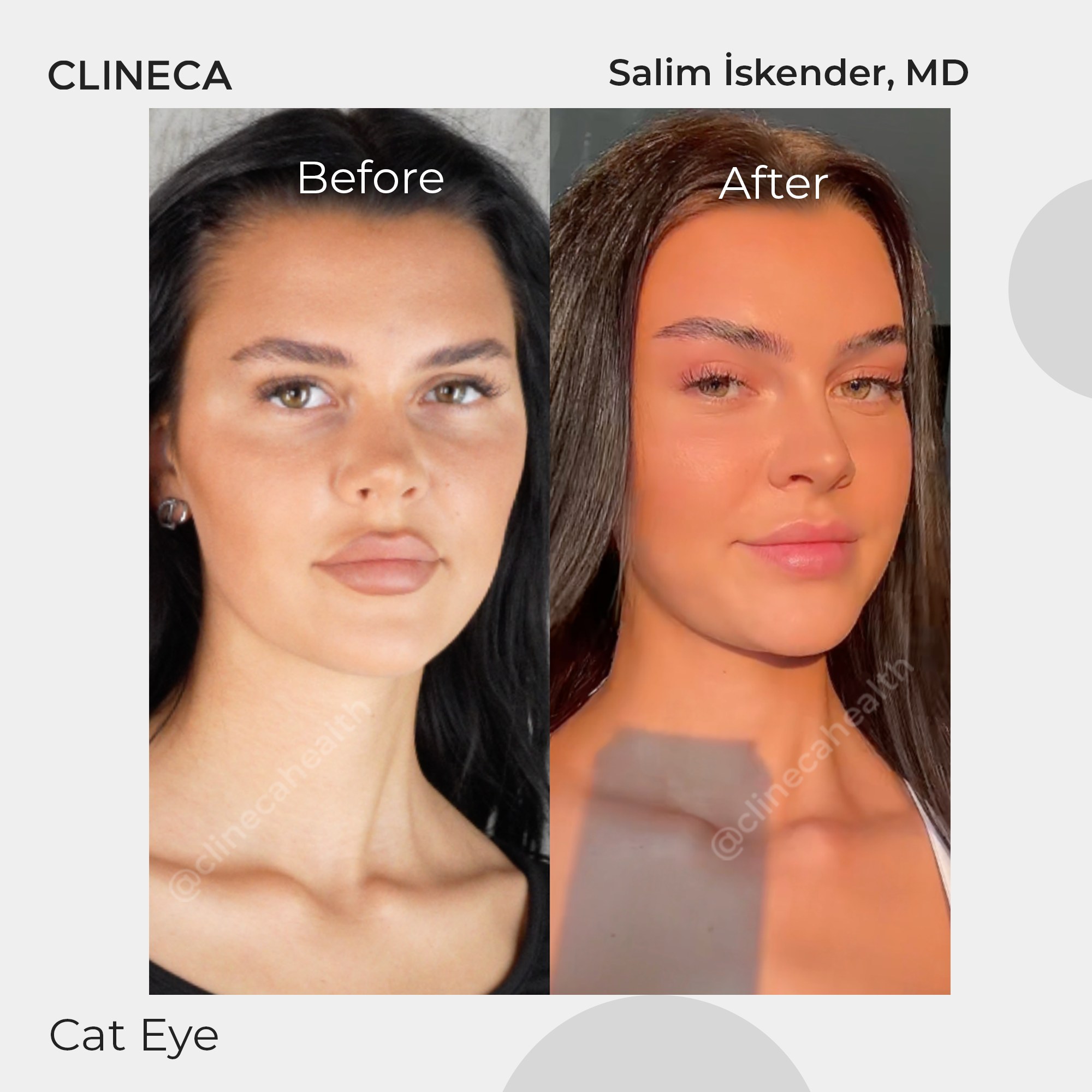 Clineca patient before and after eyelid surgery the clinic labelled cat eye, front view