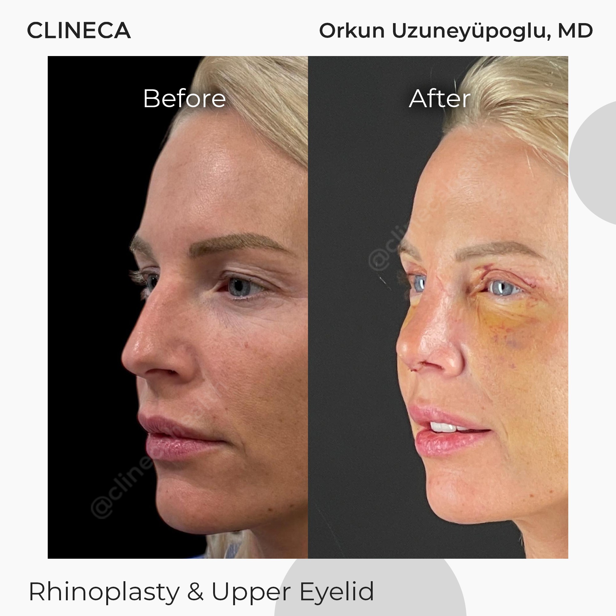 Patient in profile before eyelid surgery and in early recovery with yellow bruising under the eye