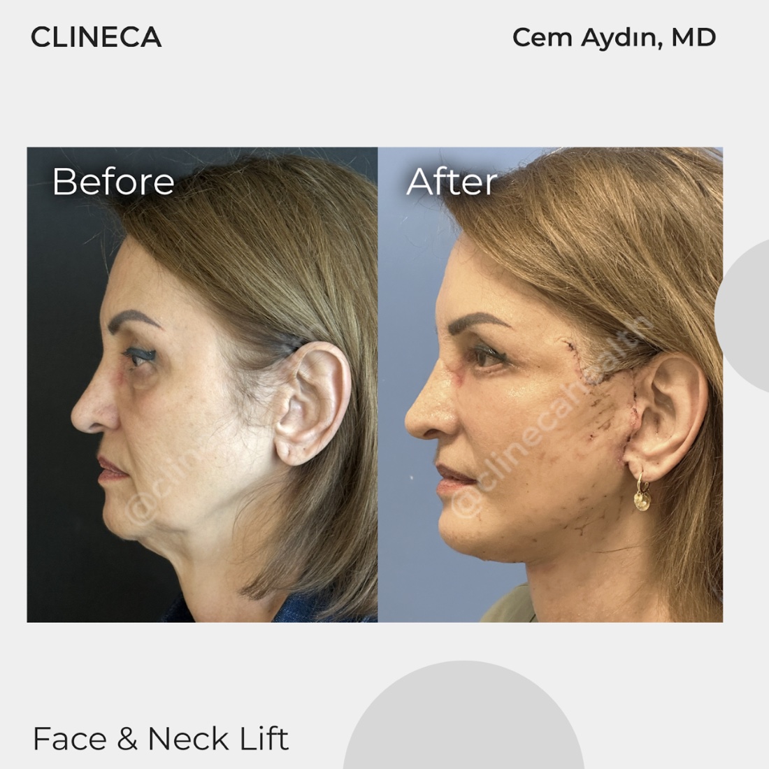 Face and neck lift patient in profile before surgery and in early recovery, with fresh incision lines in front of and behind the ear and a tighter jaw and neck line