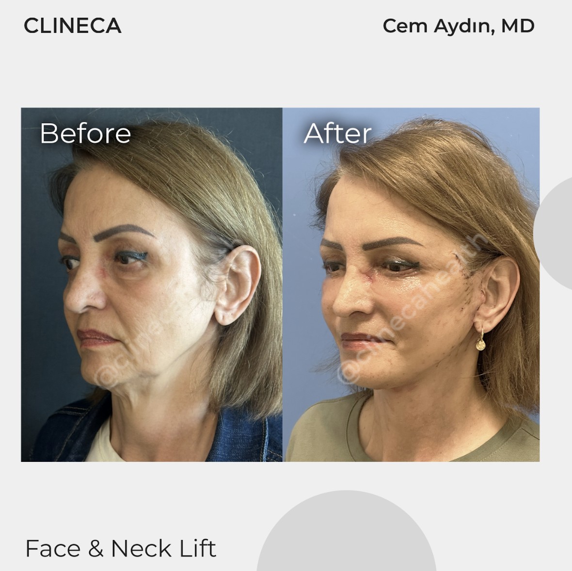 Face and neck lift patient before surgery and in early recovery with fresh sutures in front of the ear