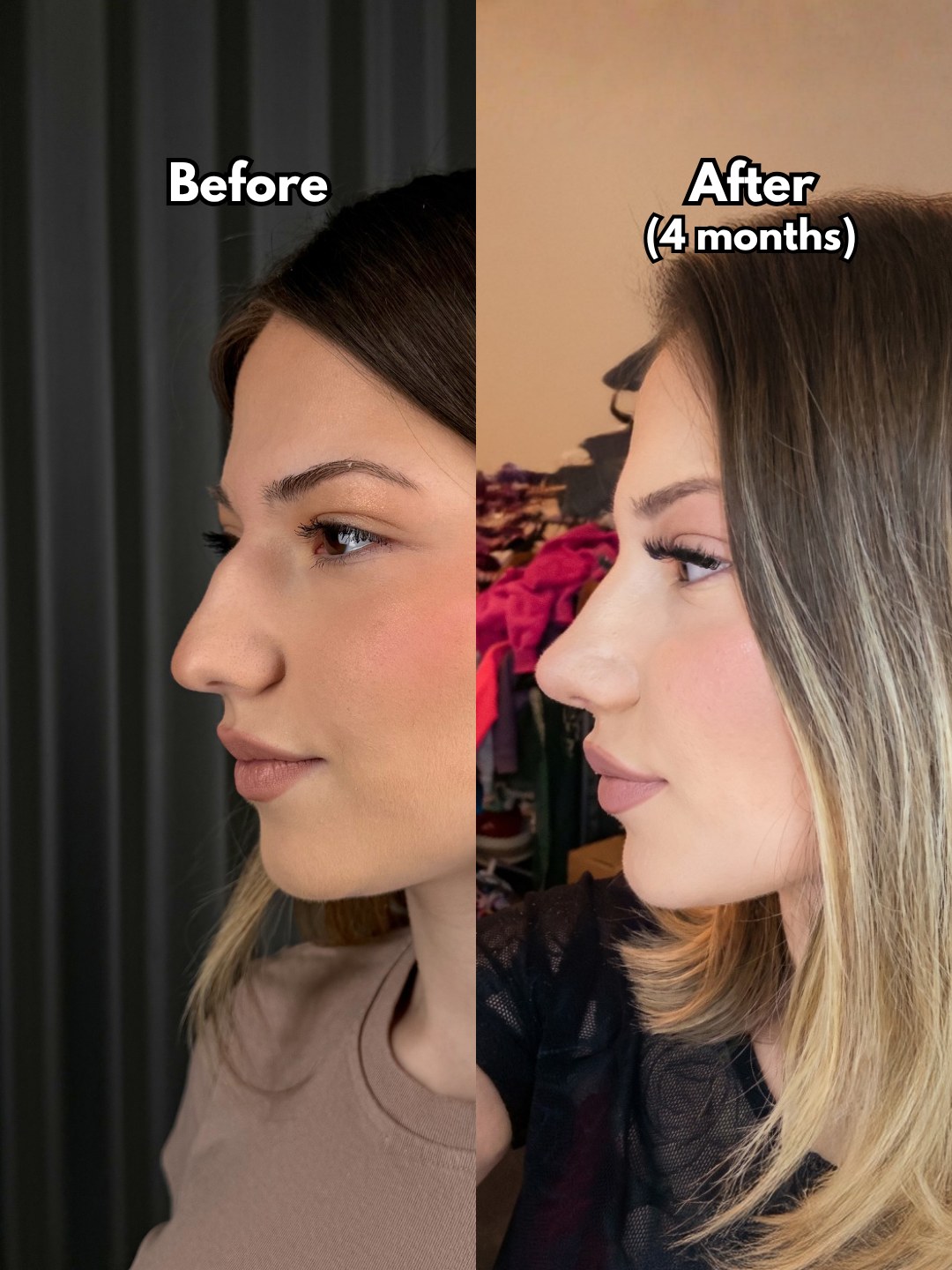 Patient in profile before surgery and four months after a full rhinoplasty, hump reduced
