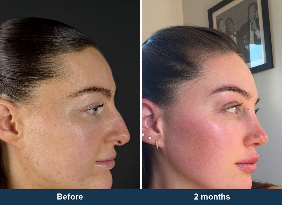 Profile view of a full rhinoplasty patient before surgery and two months after, showing the bridge line as well as the tip