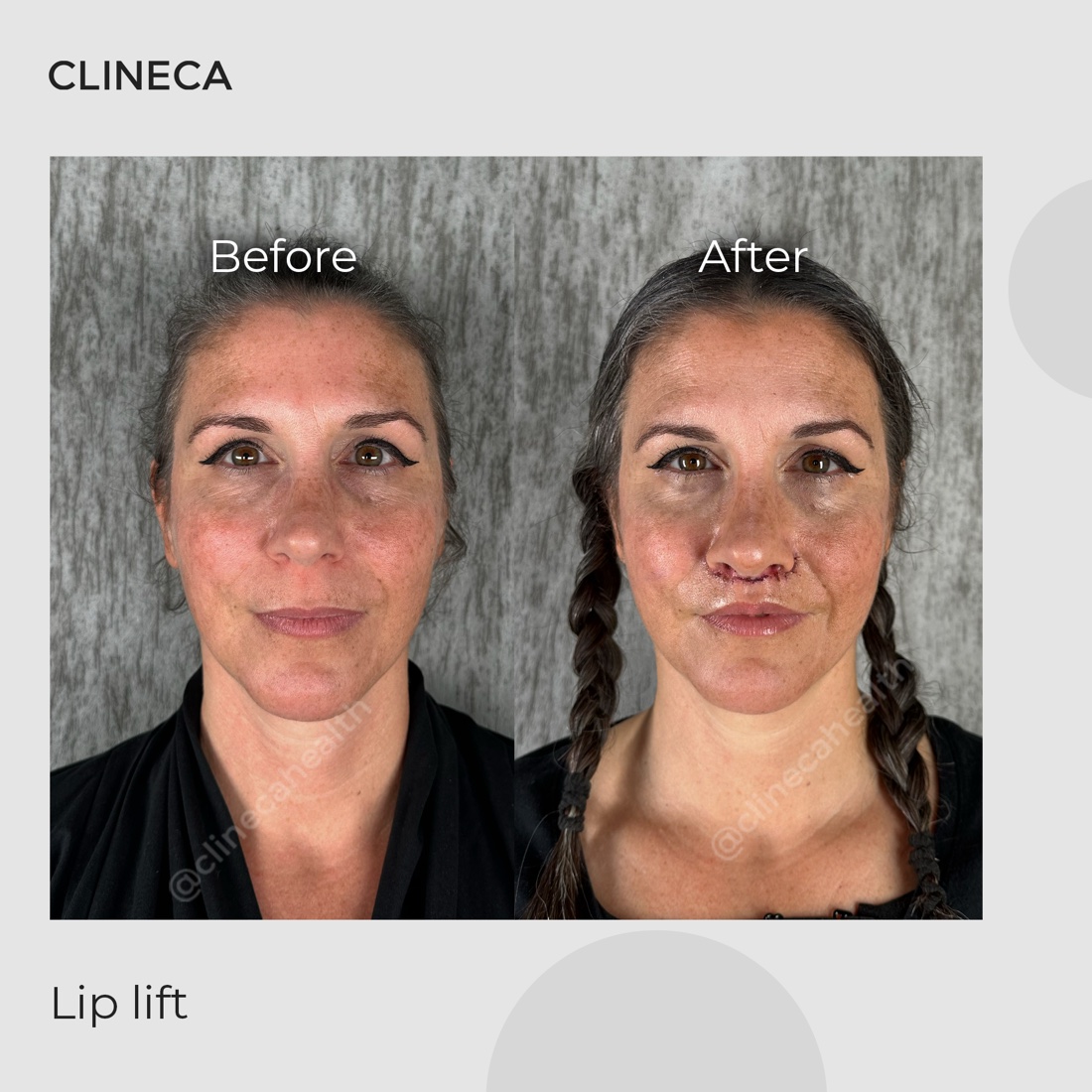 Lip lift patient photographed from the front before surgery and after, with the incision under the nose still fresh and the upper lip shortened
