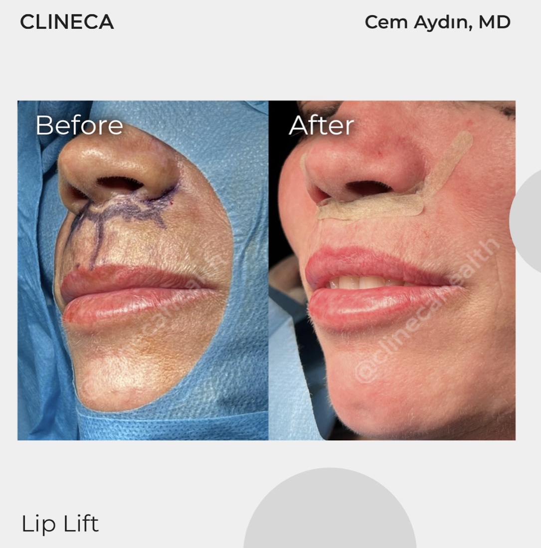 Close view of a lip lift, with the surgical plan drawn under the nose before the operation and the taped incision in the crease under the nose afterwards