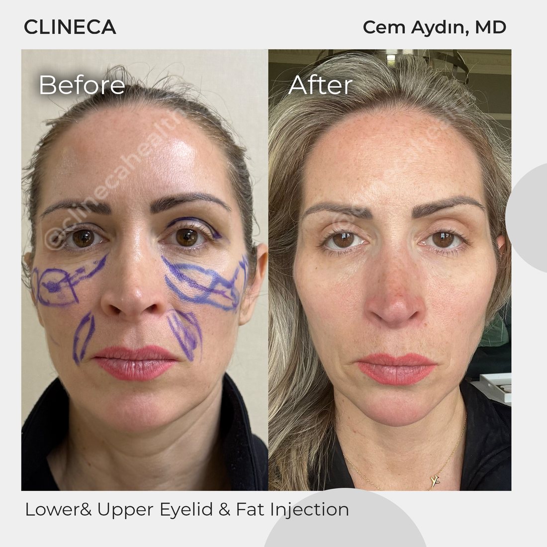 Before and after lower and upper eyelid surgery with fat injection at Clineca, with surgical planning markings visible in the before photo