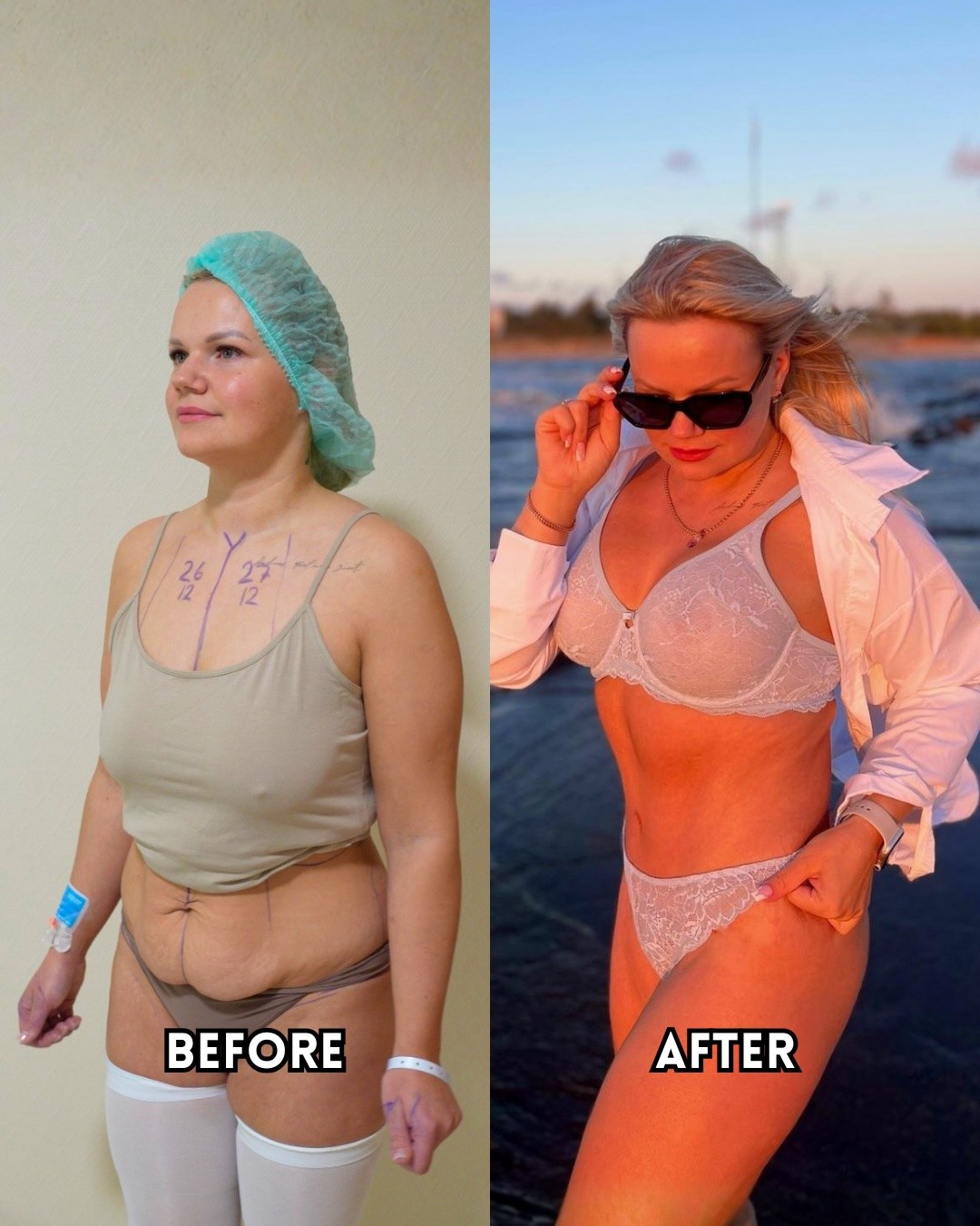 Mommy makeover patient before surgery with surgical markings on the chest and abdomen, and after recovery