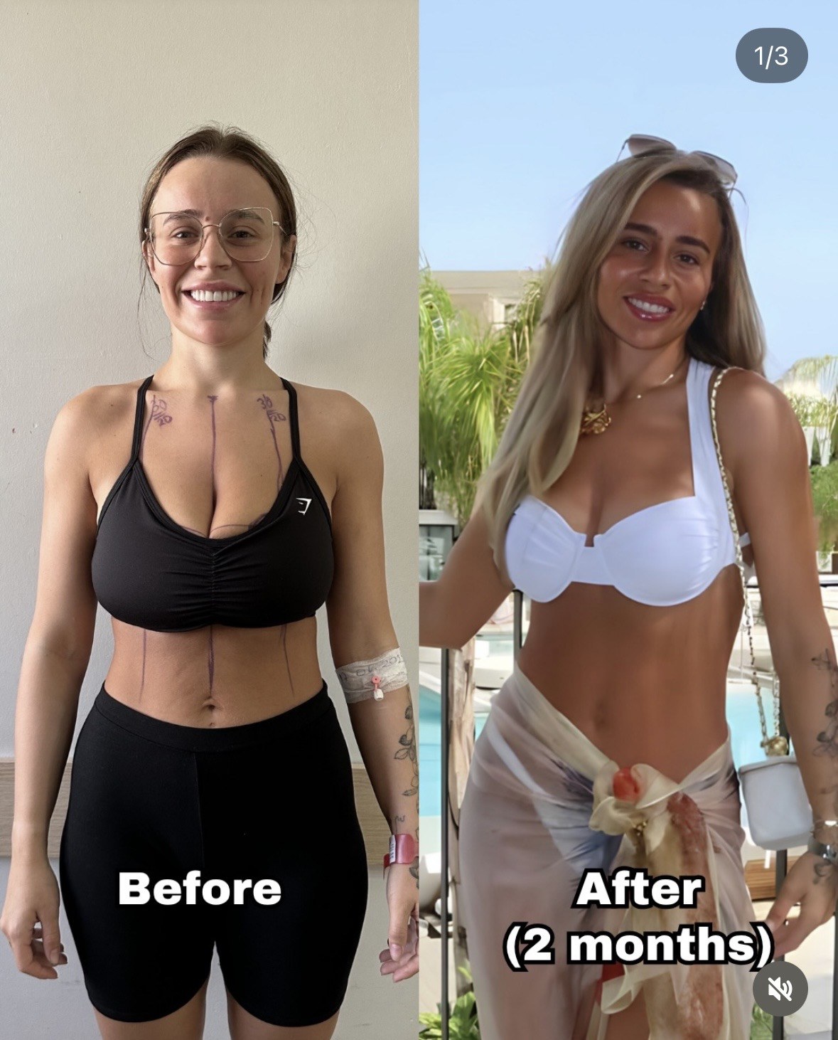 Mommy makeover patient before surgery with surgical markings on the chest and abdomen, and two months after