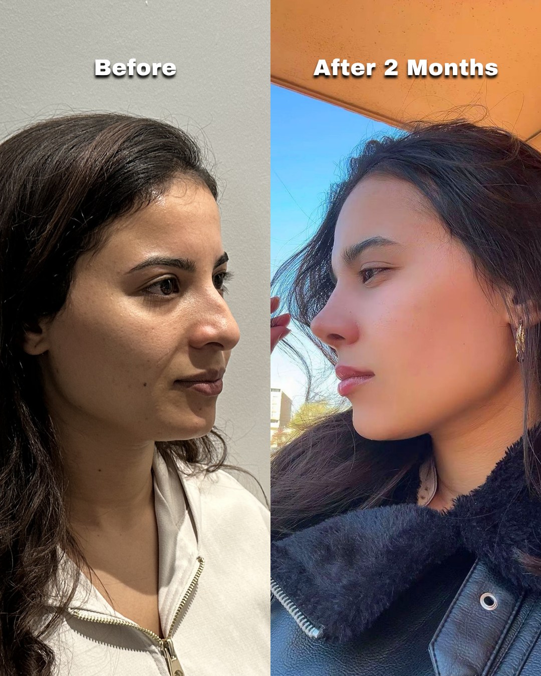 Patient in profile before nose surgery and two months after, bridge settled and tip still refining