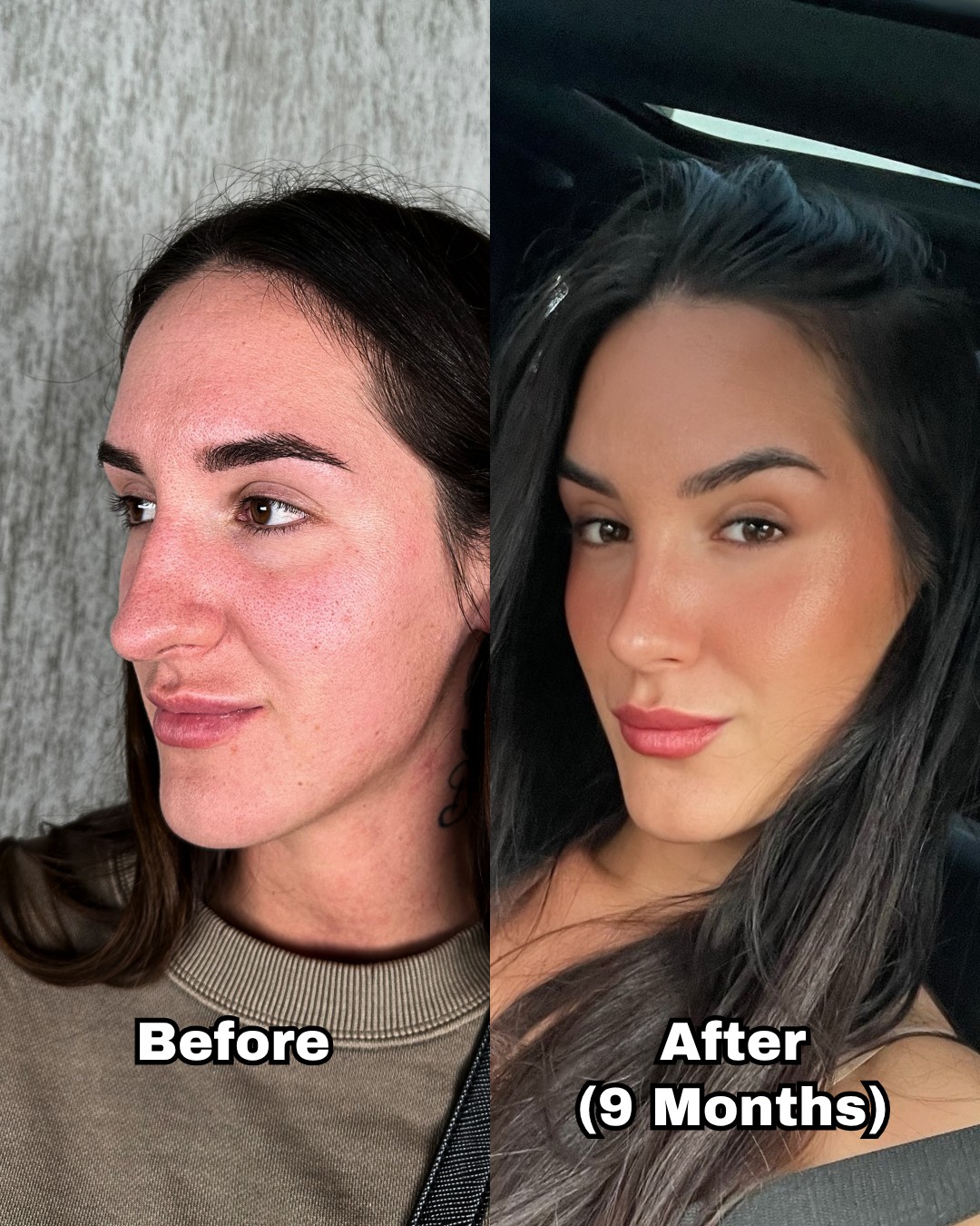Rhinoplasty patient photographed before surgery and nine months after, three-quarter view