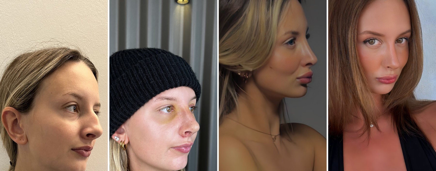 Rhinoplasty patient before surgery, seven days after with bruising under the eyes, seven months after and one year after