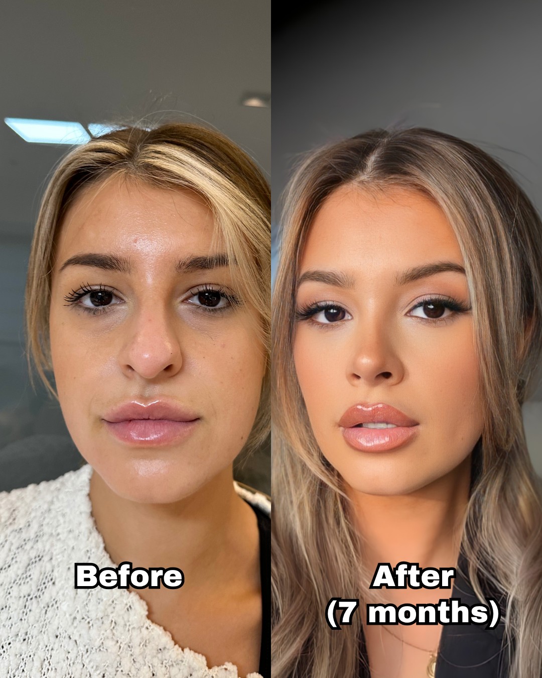 Front view of a rhinoplasty patient before surgery and seven months after
