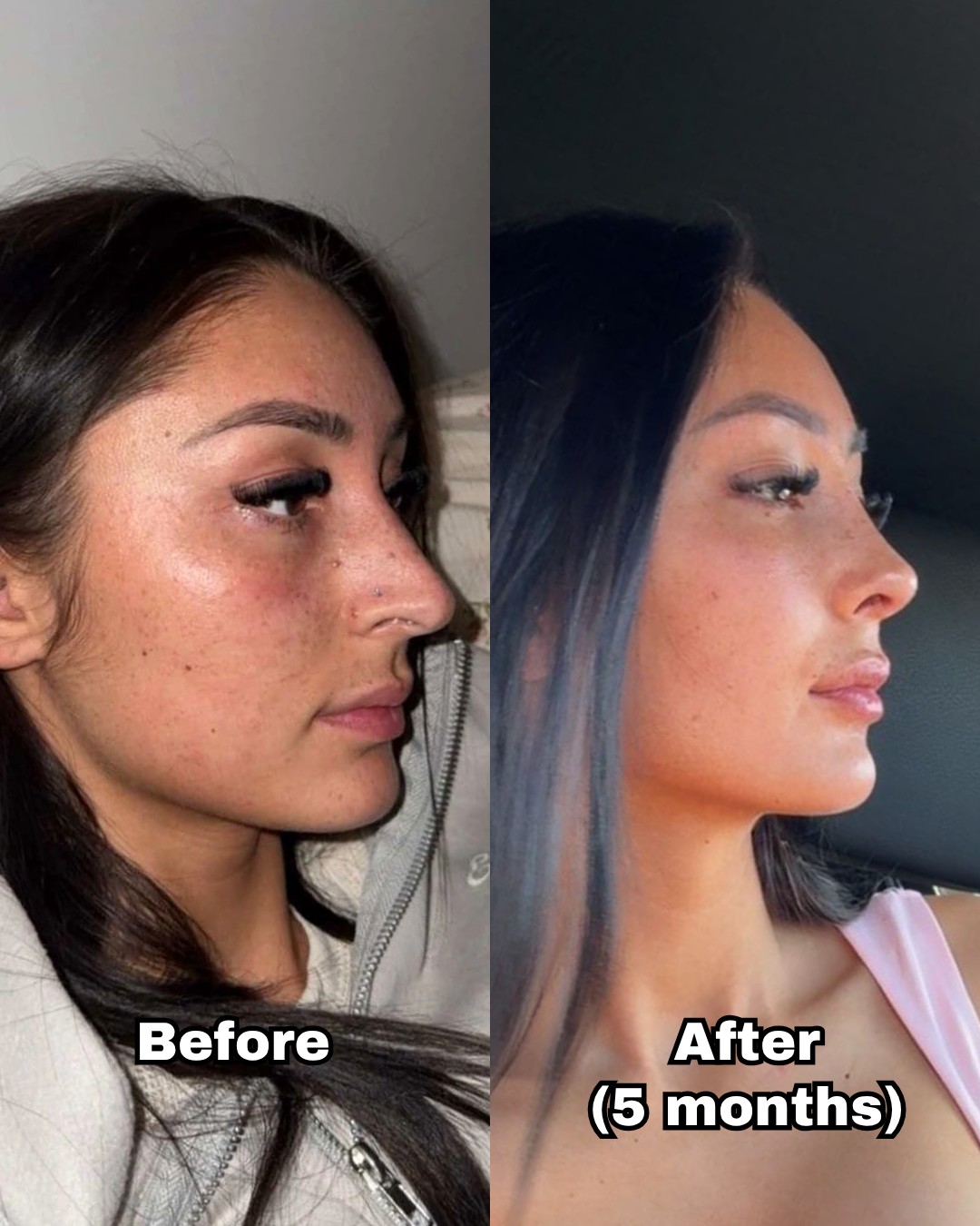 Rhinoplasty patient before surgery and five months after, showing a reduced hump and refined tip