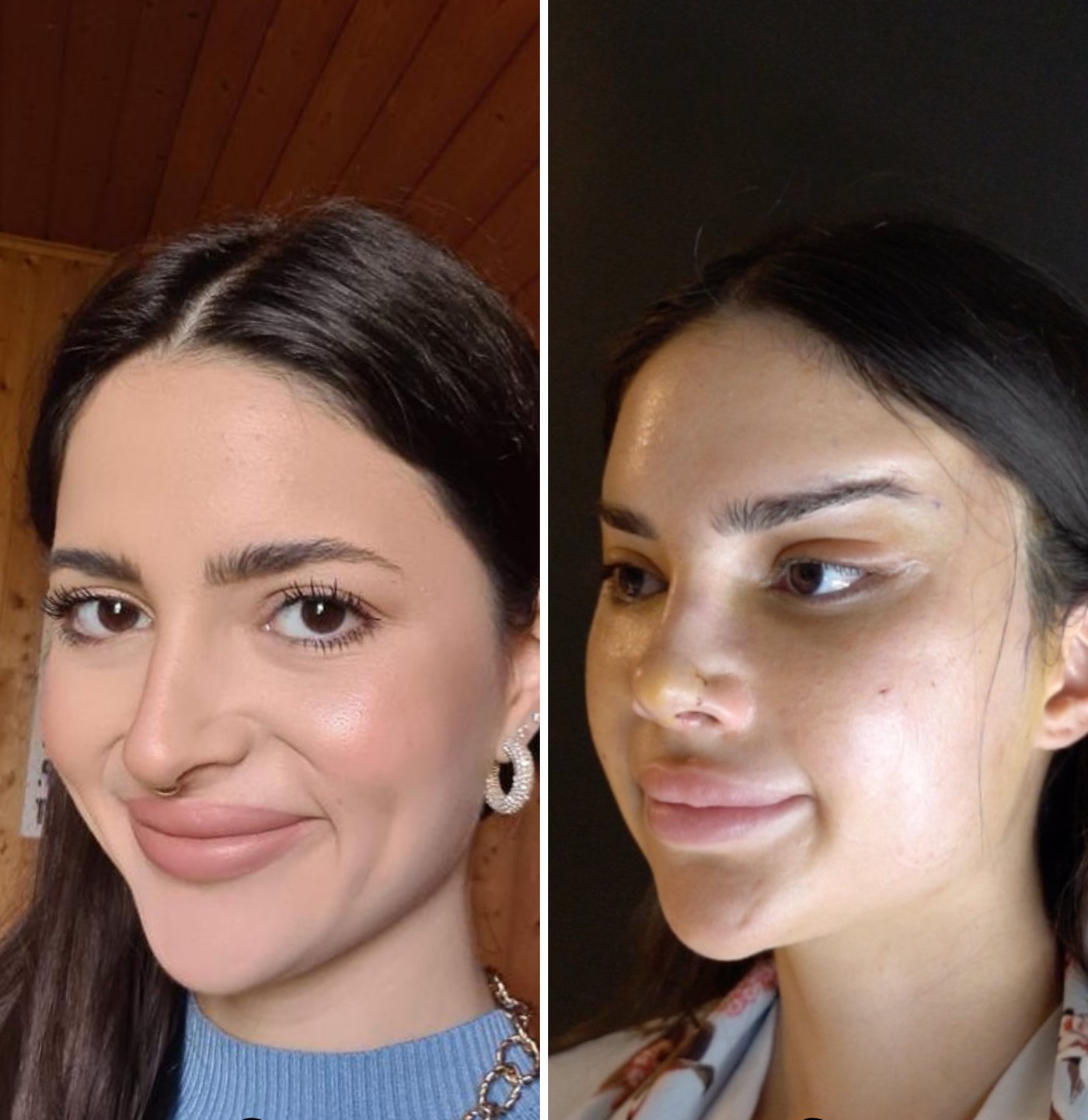 Rhinoplasty patient before surgery and seven days after, with the nose still swollen