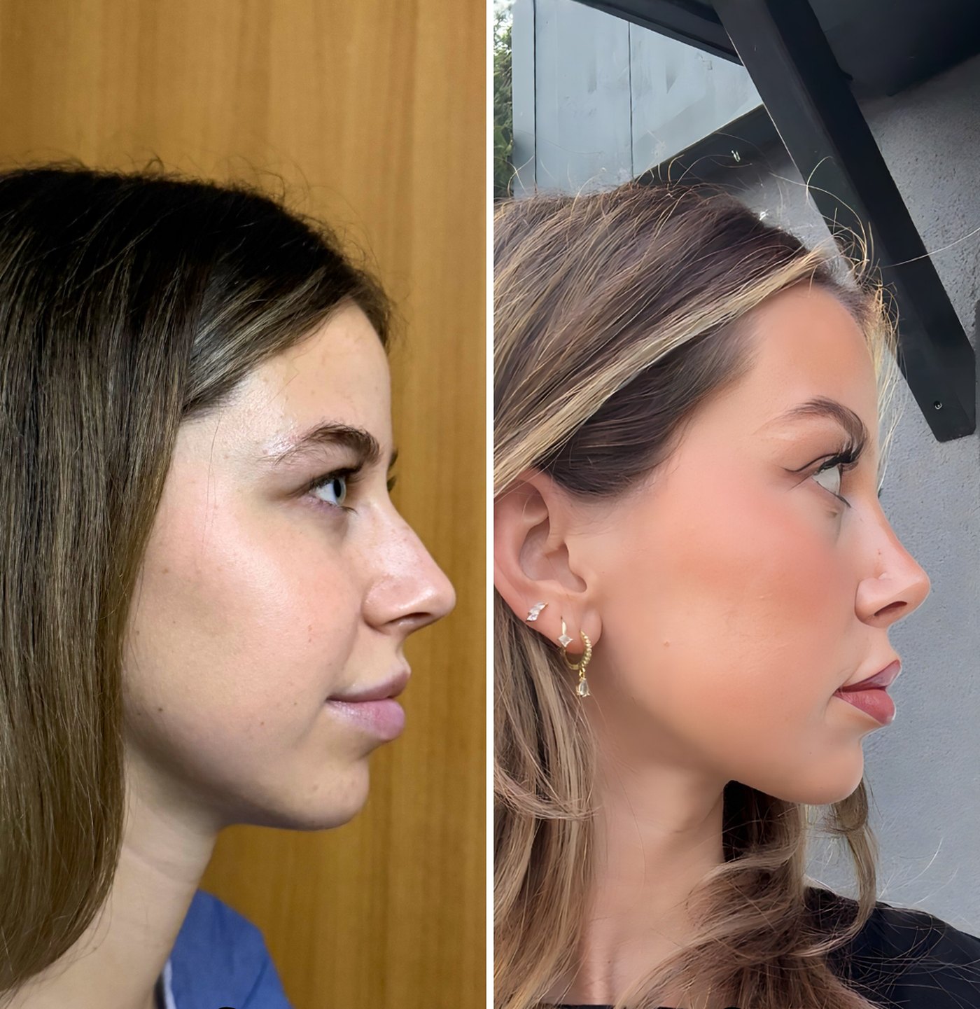 Profile view of a rhinoplasty patient before surgery and four months after, with the bridge settled and the tip still refining