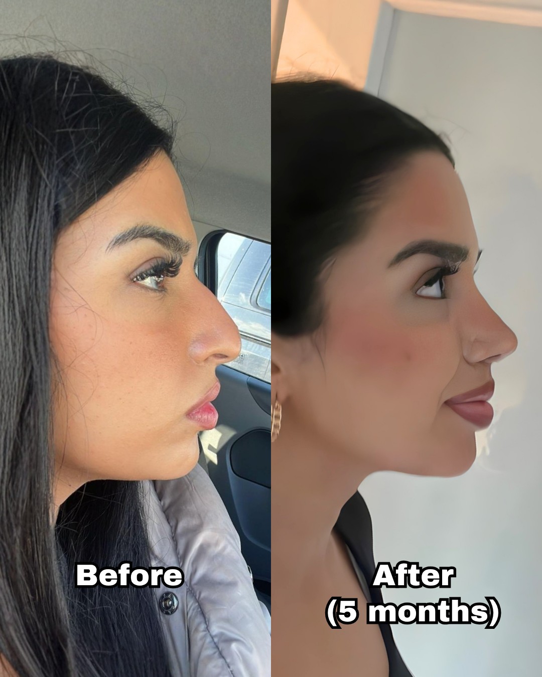 Profile view of a rhinoplasty patient before surgery and five months after, with a straighter bridge