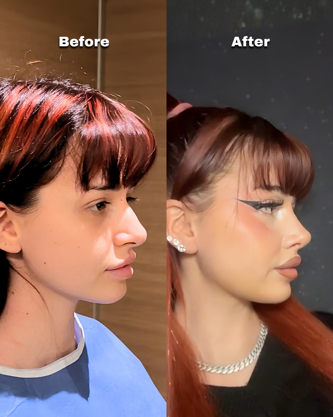 Patient in profile before and after rhinoplasty, showing the changed profile line
