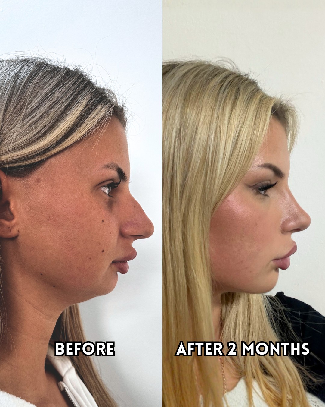 Profile view of a rhinoplasty patient before surgery and two months after, with a lowered bridge and lifted tip