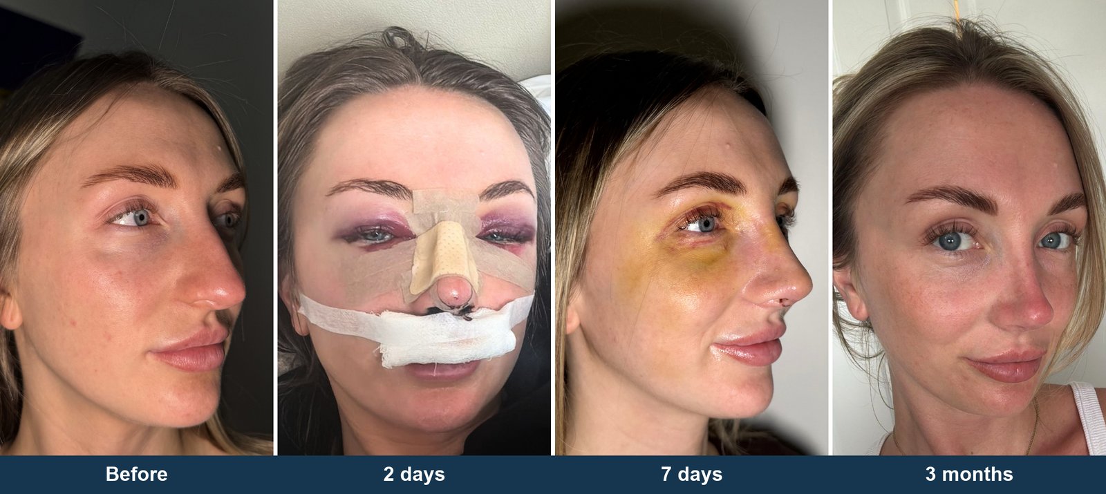The same rhinoplasty patient before surgery, two days after with the external splint on, seven days after with bruising, and three months after