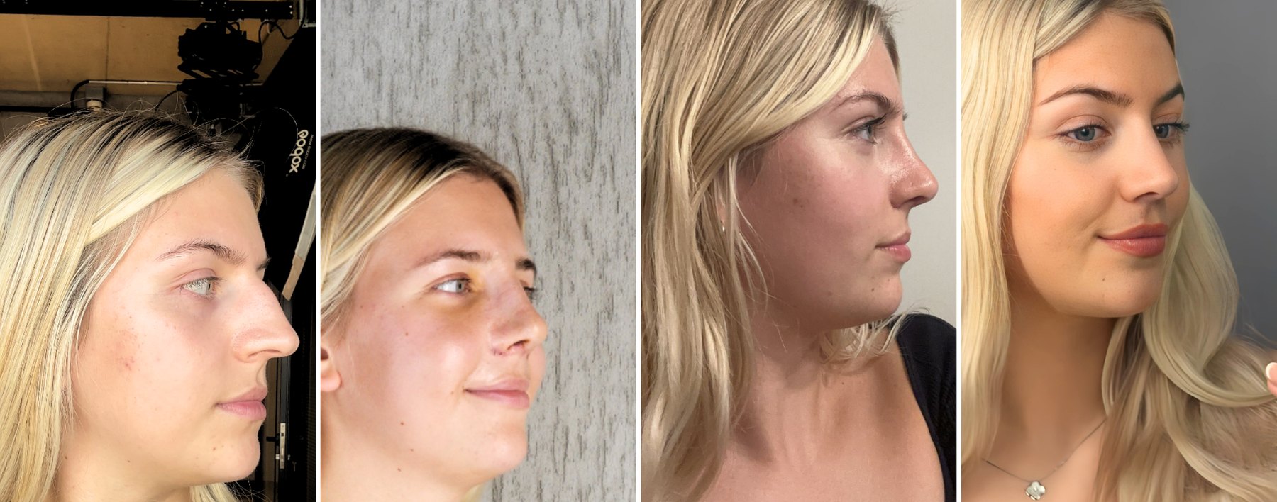 Rhinoplasty patient in profile before surgery, seven days after, one month after and four months after, showing the nose still settling