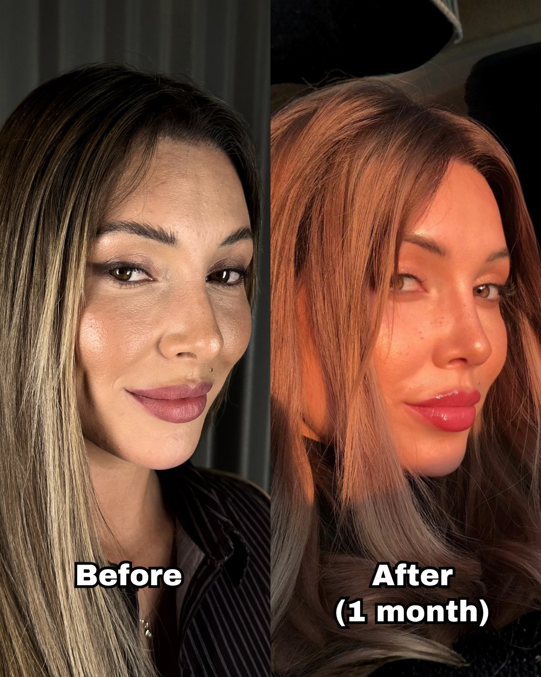Patient before surgery and one month after rhinoplasty, three-quarter view, tip and bridge changed