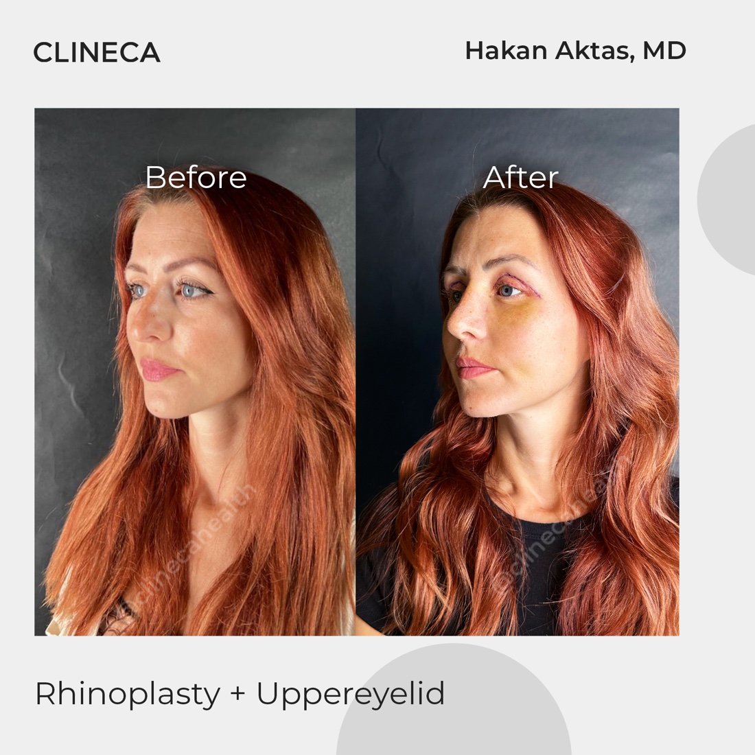 Patient who had rhinoplasty and upper eyelid surgery in the same session, before surgery and in the early recovery period with bruising along the cheek