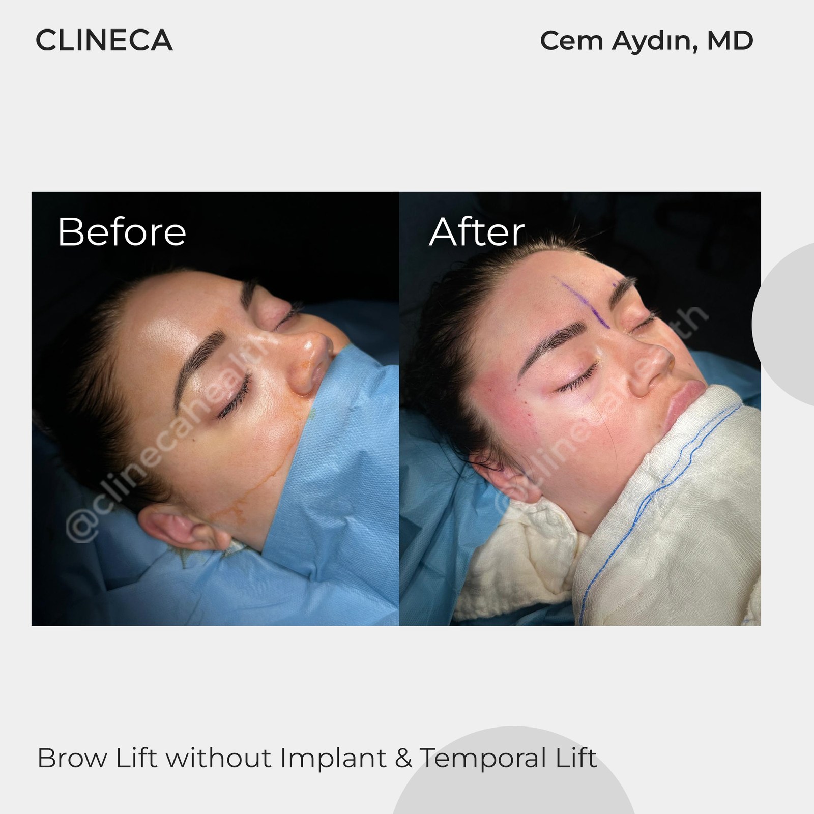 Patient photographed on the operating table before and immediately after a brow lift and temporal lift