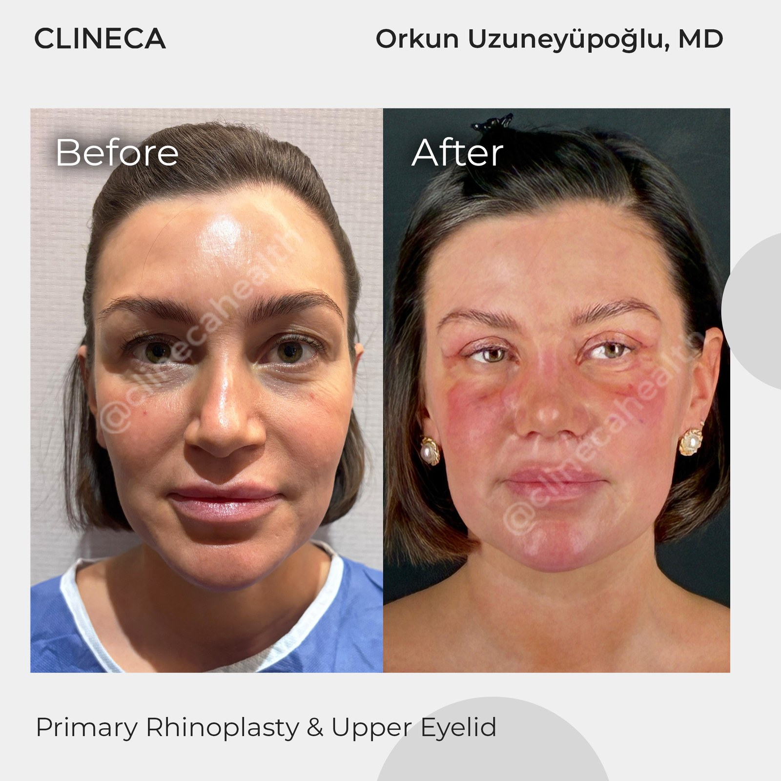 Upper eyelid surgery patient before surgery and in the early healing stage, with swollen, red eyelids