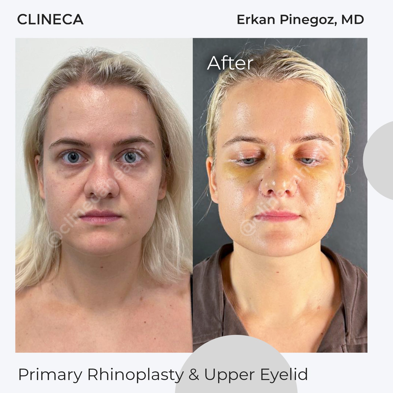 Patient before surgery and in the early healing stage after upper eyelid surgery and rhinoplasty in one session