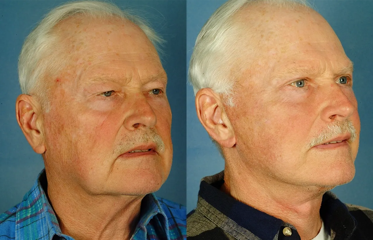 Facelift before and after, male patient: jowls and loose skin along the jawline before, tighter jawline after