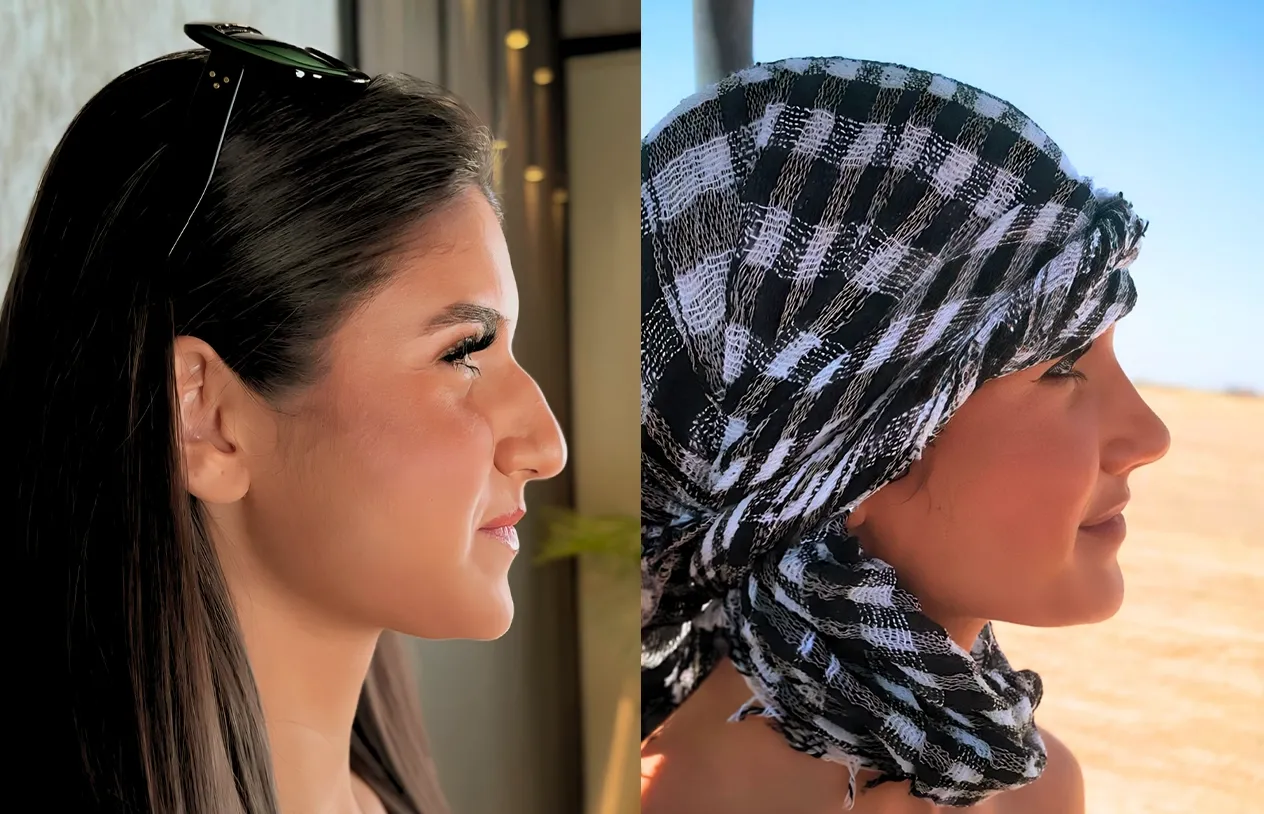 UK patient in her twenties, rhinoplasty before and after in profile: bridge hump and drooping tip before, straight bridge and lifted tip after