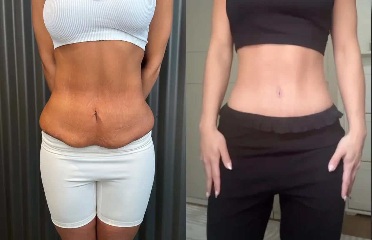Tummy tuck before and after, front view: loose lower abdominal skin before, flat and tight after